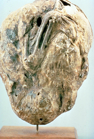 Este feto muerto y calcificado pasó en torno a 50 años en el vientre de su madre. Wikimedia C.